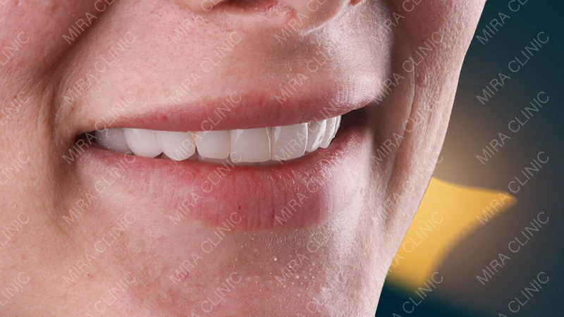 Hollywood smile before after 